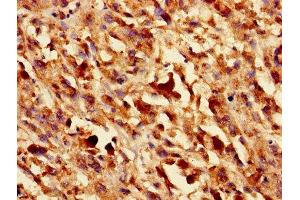 Immunohistochemistry of paraffin-embedded human melanoma using ABIN7153440 at dilution of 1:100