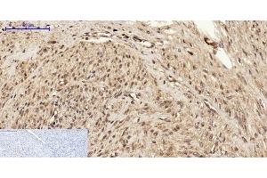 Immunohistochemistry of paraffin-embedded Human uterus cancer tissue using BRCA1 Polyclonal Antibody at dilution of 1:200. (BRCA1 抗体)