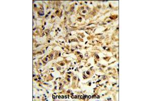 Formalin-fixed and paraffin-embedded human breast carcinoma reacted with MAT2B Antibody (N-term), which was peroxidase-conjugated to the secondary antibody, followed by DAB staining. (MAT2B 抗体  (N-Term))