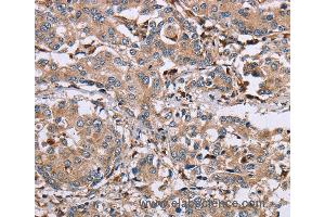 Immunohistochemistry of Human liver cancer using MAGEA3 Polyclonal Antibody at dilution of 1:50 (MAGEA3 抗体)