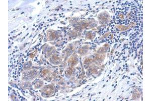 IHC-P Image Immunohistochemical analysis of paraffin-embedded human breast cancer, using SERPINB6 antibody, antibody at 1:500 dilution. (SERPINB6 抗体  (Internal Region))