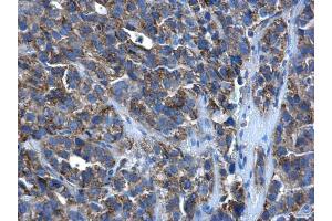 IHC-P Image PEX26 antibody detects PEX26 protein at cytoplasm in human cervical cancer by immunohistochemical analysis. (PEX26 抗体)