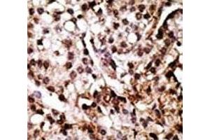 IHC analysis of FFPE human breast carcinoma tissue stained with the ATG7 antibody (ATG7 抗体  (AA 22-51))