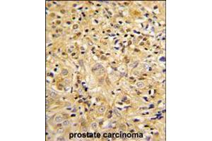 Formalin-fixed and paraffin-embedded human prostate carcinoma reacted with LUM Antibody , which was peroxidase-conjugated to the secondary antibody, followed by DAB staining. (LUM 抗体  (AA 198-227))