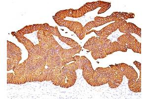 Formalin-fixed, paraffin-embedded human Colon Carcinoma stained with EpCAM Mouse Monoclonal Antibody (EGP40/837). (EpCAM 抗体)