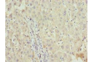 Immunohistochemistry of paraffin-embedded human liver cancer using ABIN7176188 at dilution of 1:100 (ZNF253 抗体  (AA 80-300))