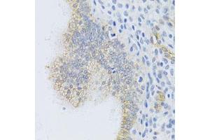 Immunohistochemistry of paraffin-embedded human uterine cancer using ABCC1 Antibody. (ABCC1 抗体)