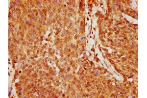 IHC image of ABIN7153409 diluted at 1:200 and staining in paraffin-embedded human cervical cancer performed on a Leica BondTM system. (GABPA 抗体  (AA 268-372))