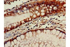 Immunohistochemistry of paraffin-embedded human colon cancer using ABIN7154664 at dilution of 1:100 (GNGT1 抗体  (AA 2-65))