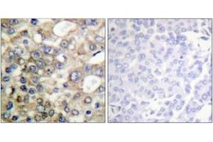 Immunohistochemistry analysis of paraffin-embedded human breast carcinoma, using CD227/MUC1 (Phospho-Tyr1229) Antibody. (MUC1 抗体  (pTyr1229))