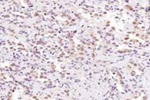 Immunohistochemistry analysis of paraffin-embedded human lung cancer using SRFBP1 (ABIN7075579) at dilution of 1: 2000 (SRFBP1 抗体)