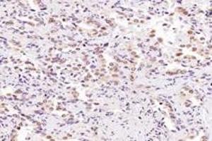 Immunohistochemistry analysis of paraffin-embedded human lung cancer using SRFBP1 (ABIN7075579) at dilution of 1: 2000