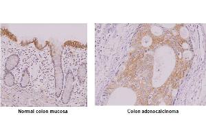 Paraffin embedded sections of normal colon mucosa and colon adenocalcinoma tissue were incubated with anti-human IRF-5 antibody (1:50) for 2 hours at room temperature. (IRF5 抗体)