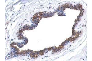 IHC-P Image Immunohistochemical analysis of paraffin-embedded human breast cancer, using MAPK4, antibody at 1:500 dilution. (MAPK4 抗体)