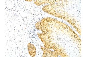 Formalin-fixed, paraffin-embedded human Cervical Carcinoma stained with p27 Mouse Monoclonal Antibody (KIP1/769). (CDKN1B 抗体)