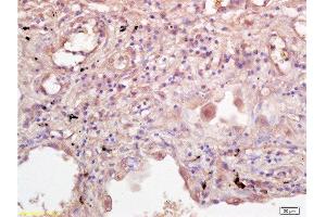 Formalin-fixed and paraffin embedded human lung tissue labeled with Rabbit Anti-IL-2R gamma Polyclonal Antibody  at 1:200 followed by conjugation to the secondary antibody and DAB staining. (IL2RG 抗体  (AA 51-150))