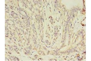 Immunohistochemistry of paraffin-embedded human breast cancer using ABIN7157158 at dilution of 1:100 (JUP 抗体  (AA 1-131))
