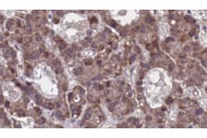 ABIN6273912 at 1/100 staining Human liver cancer tissue by IHC-P. (GPR77 抗体  (C-Term))