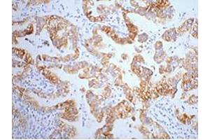 IHC-P staining of human lung cancer tissue, diluted at 1:200. (Cytokeratin 7 抗体)