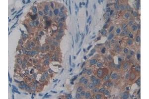 Detection of NEIL1 in Human Lung cancer Tissue using Polyclonal Antibody to Nei Endonuclease VIII Like Protein 1 (NEIL1) (NEIL1 抗体  (AA 43-314))