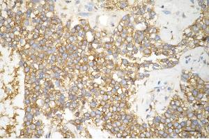 Immunohistochemistry was performed on paraffin-embedded human breast carcinoma using phospho-eIF4B (S406) antibody (ABIN7798527), 1:200). (Recombinant EIF4B 抗体  (pSer406))