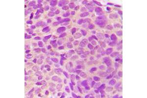 Immunohistochemical analysis of MST3 staining in human breast cancer formalin fixed paraffin embedded tissue section. (STK24 抗体  (C-Term))