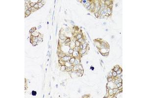 Immunohistochemistry of paraffin-embedded human gastric cancer using IER3 antibody at dilution of 1:100 (x40 lens). (IER3 抗体)
