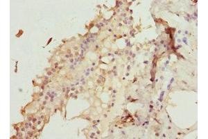 Immunohistochemistry of paraffin-embedded human breast cancer using ABIN7176187 at dilution of 1:100 (ZNF24 抗体  (AA 169-368))