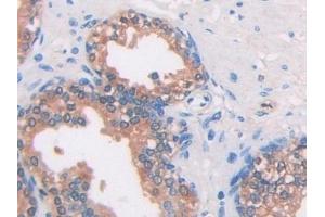 Immunohistochemistry (IHC) image for anti-Isocitrate Dehydrogenase 1 (NADP+), Soluble (IDH1) (AA 74-333) antibody (ABIN7427219)