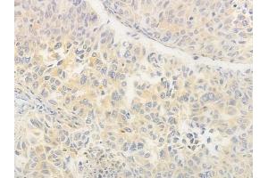 ABIN6264552 and ABIN6276570 at 1/100 staining human lung squamous cell carcinoma by IHC-P.