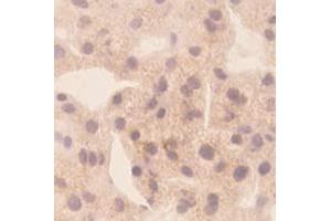 Immunohistochemical staining of human liver cancer tissue section with CXCL10 monoclonal antibody, clone 1  at 1:10 dilution.