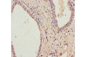 Immunohistochemistry of paraffin-embedded human prostate cancer using ABIN7167832 at dilution of 1:100 (RDH11 抗体  (AA 22-318))