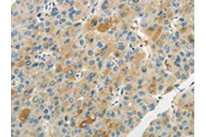 The image on the left is immunohistochemistry of paraffin-embedded Human liver cancer tissue using ABIN7193065(WNT2B Antibody) at dilution 1/20, on the right is treated with synthetic peptide.
