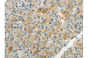 The image on the left is immunohistochemistry of paraffin-embedded Human liver cancer tissue using ABIN7193065(WNT2B Antibody) at dilution 1/20, on the right is treated with synthetic peptide. (WNT2B 抗体)