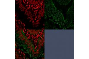 Confocal Immunofluorescence of human Colo-rectal Carcinoma. (EpCAM 抗体  (Extracellular Domain))