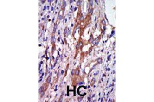 Formalin-fixed and paraffin-embedded human hepatocellular carcinoma tissue reacted with AURKA polyclonal antibody  , which was peroxidase-conjugated to the secondary antibody, followed by DAB staining. (Aurora A 抗体  (N-Term))