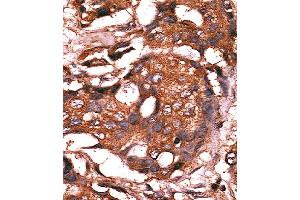 Formalin-fixed and paraffin-embedded human cancer tissue reacted with the primary antibody, which was peroxidase-conjugated to the secondary antibody, followed by AEC staining. (GUCY1A1 抗体  (N-Term))