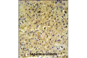 INSC Antibody IHC analysis in formalin fixed and paraffin embedded hepatocarcinoma followed by peroxidase conjugation of the secondary antibody and DAB staining. (INSC 抗体  (AA 410-437))
