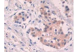 Detection of STC1 in Human Breast cancer Tissue using Polyclonal Antibody to Stanniocalcin 1 (STC1) (Stanniocalcin 1 抗体  (AA 28-247))