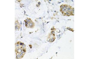 Immunohistochemistry of paraffin-embedded human gastric cancer using GALC antibody at dilution of 1:100 (x40 lens). (GALC 抗体)