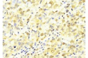 ABIN6277569 at 1/100 staining Human breast cancer tissue by IHC-P. (HUS1 抗体  (Internal Region))