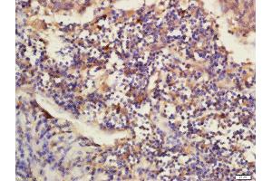 Formalin-fixed and paraffin embedded human laryngo carcinoma labeled with Rabbit Anti-DNAJB12 Polyclonal Antibody, Unconjugated (ABIN2173711) at 1:200 followed by conjugation to the secondary antibody and DAB staining (DNAJB12 抗体  (AA 26-130))