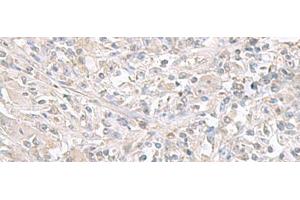 Immunohistochemistry of paraffin-embedded Human liver cancer tissue using FXYD6 Polyclonal Antibody at dilution of 1:65(x200) (FXYD6 抗体)