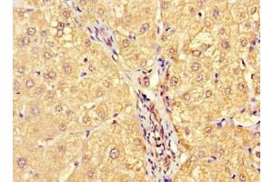 Immunohistochemistry of paraffin-embedded human liver cancer using ABIN7143724 at dilution of 1:100 (Allergin-1 抗体  (AA 249-343))