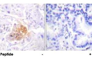 Immunohistochemical analysis of paraffin-embedded human lung carcinoma tissue using IL2RB polyclonal antibody . (IL2 Receptor beta 抗体)