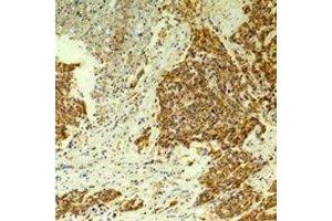 Immunohistochemical analysis of CLIC4 staining in human breast cancer,rat brain formalin fixed paraffin embedded tissue section. (CLIC4 抗体)