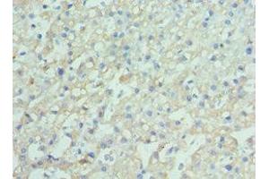 Immunohistochemistry of paraffin-embedded human liver cancer using ABIN7151389 at dilution of 1:100 (ENPP2 抗体  (AA 564-863))