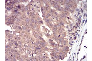 Immunohistochemical analysis of paraffin-embedded ovarian cancer tissues using SLINGSHOT-1L mouse mAb with DAB staining.