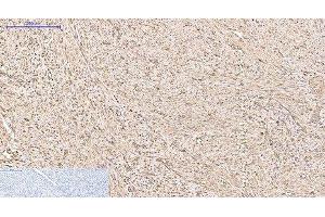 Immunohistochemistry of paraffin-embedded Human uterus cancer tissue using PRDX1 Monoclonal Antibody at dilution of 1:200. (Peroxiredoxin 1 抗体)
