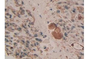 Detection of CK7 in Human Lung cancer Tissue using Polyclonal Antibody to Cytokeratin 7 (CK7) (Cytokeratin 7 抗体  (AA 91-394))